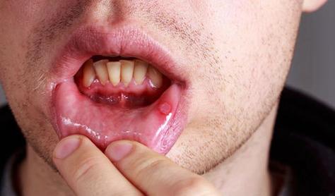口腔常见疾病的相关图片