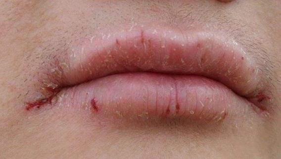 嘴唇肿是什么原因的相关图片