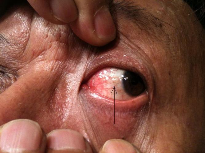 眼睑裂斑初期图片的相关图片